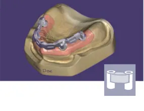 exocad - Bar Add On Module